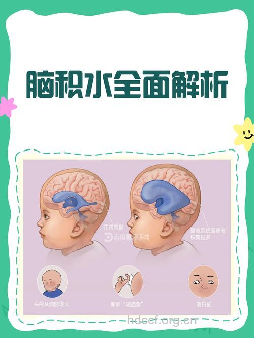 怎么认识脑积水方法