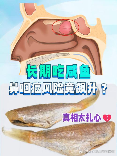 爱吃咸鱼会引发鼻咽癌