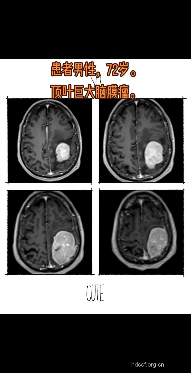 怎么确诊顶叶肿瘤