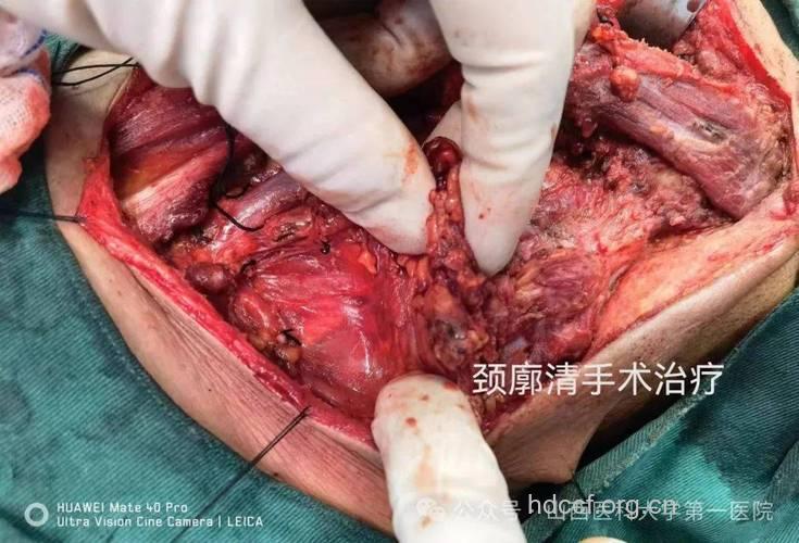 切除术治疗鼻咽癌