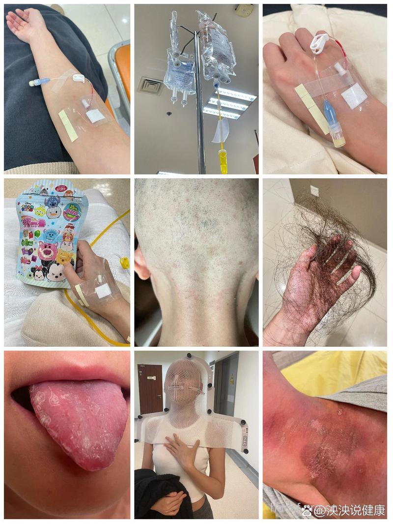 鼻咽癌放射治疗后的效果