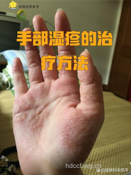 怎么应对手部干燥性湿疹