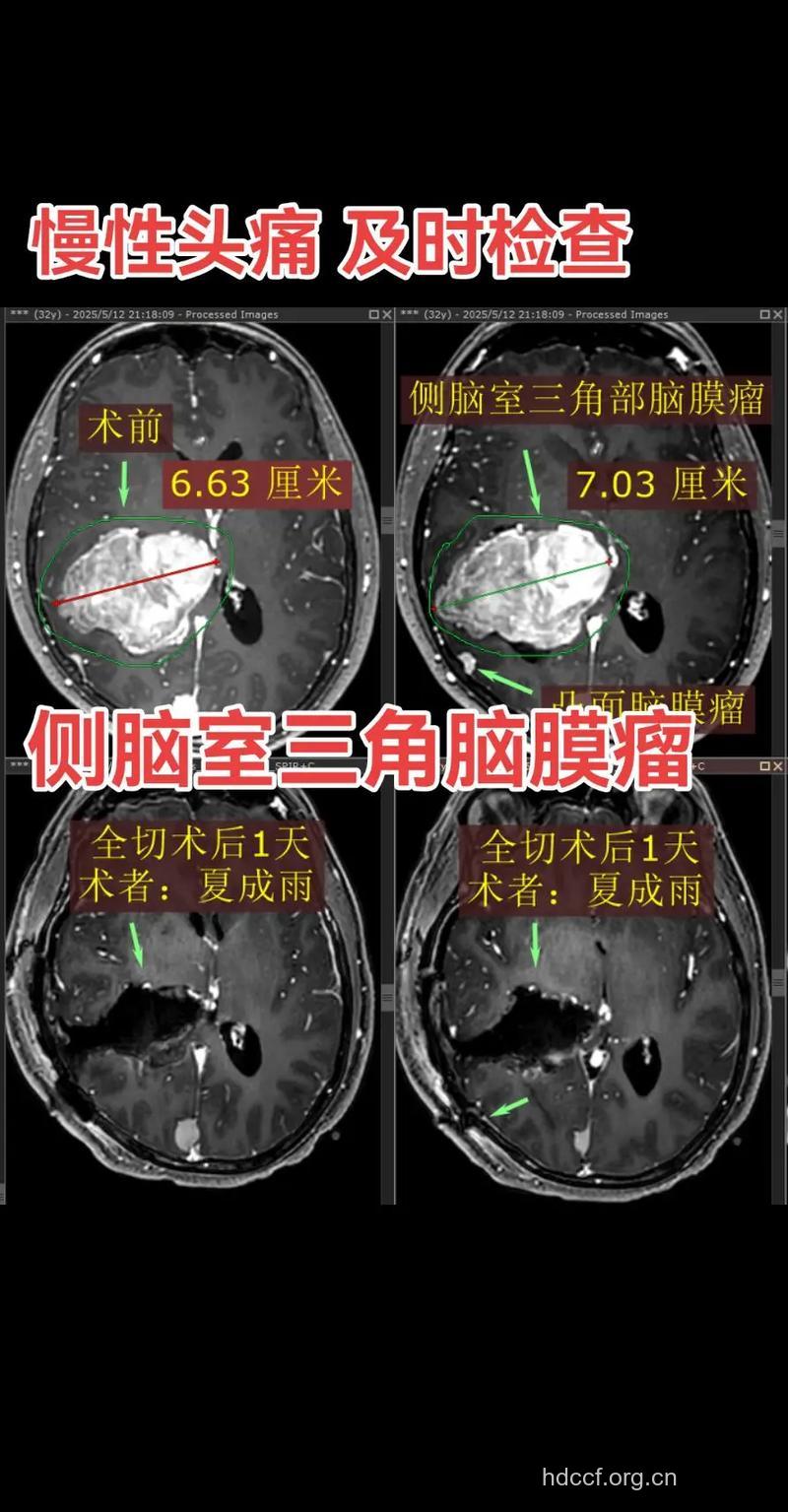 侧脑室肿瘤要做什么检查