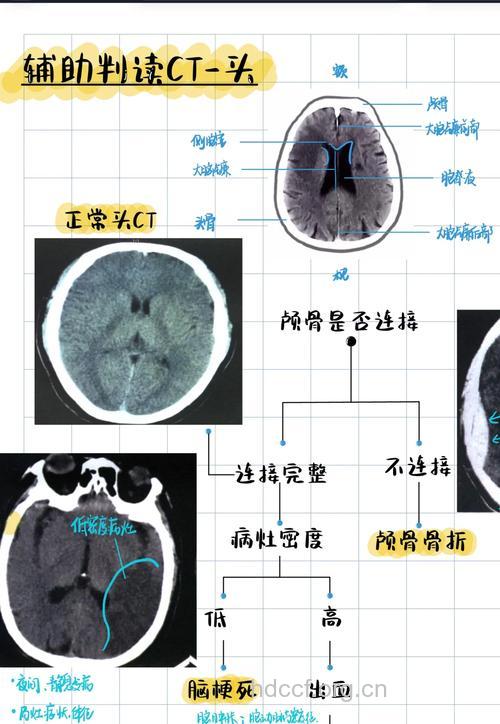 头部外伤怎么进行CT检查