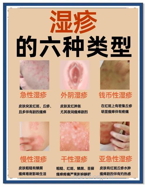 阴部湿疹有什么预防措施