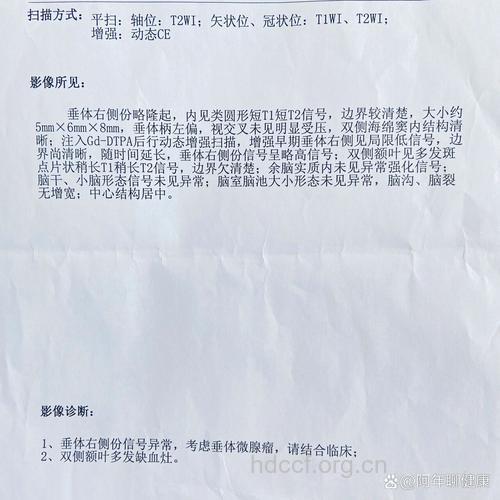 垂体瘤有哪些诊断依据