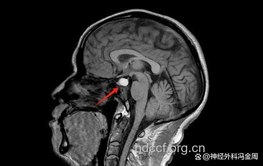 垂体瘤有哪些检查方法