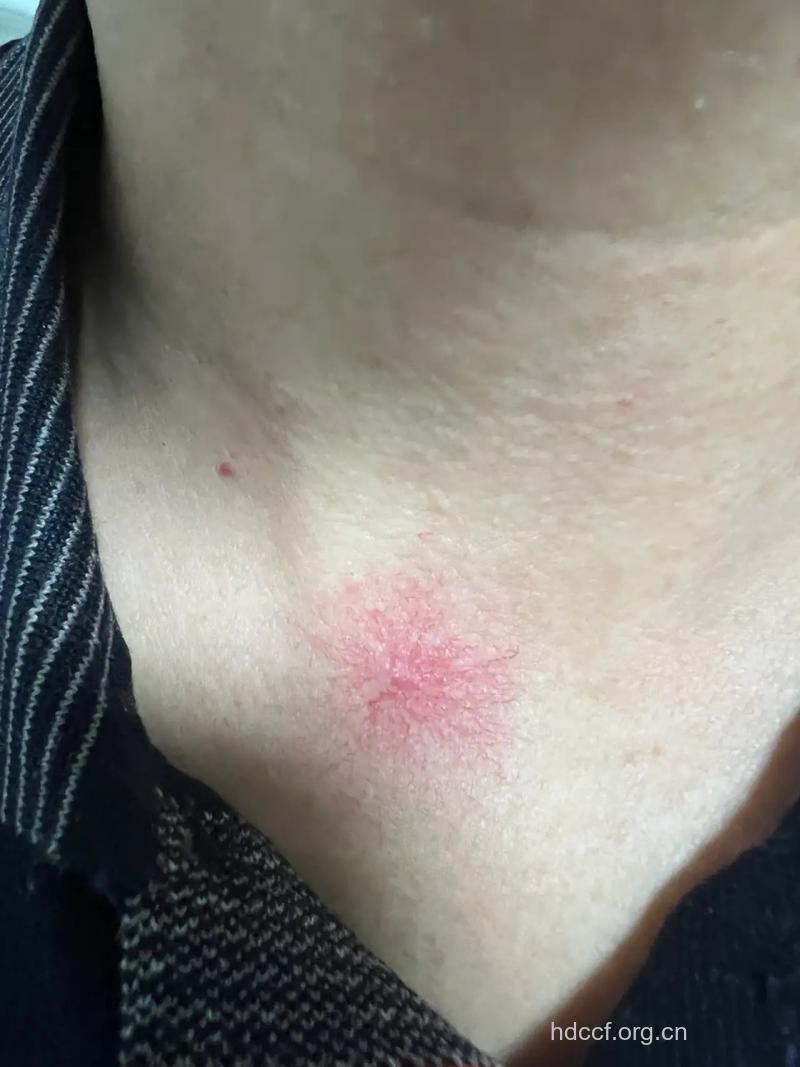 大三阳出现的蜘蛛痣