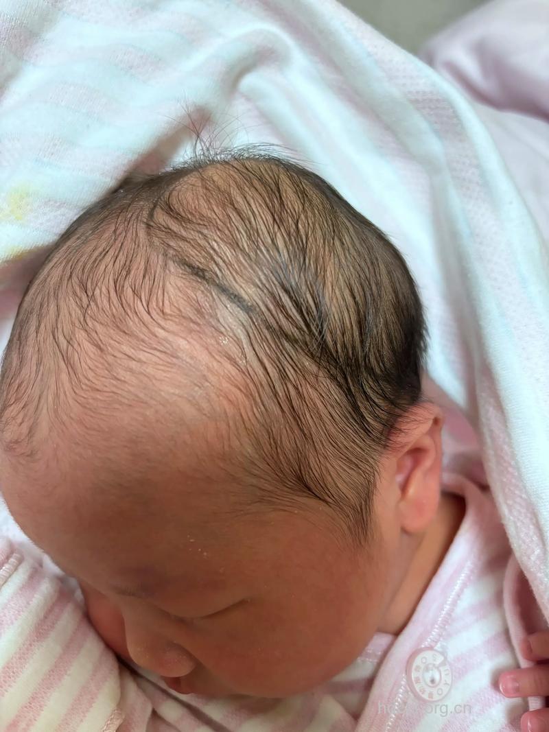 怎么应对头皮血肿方法