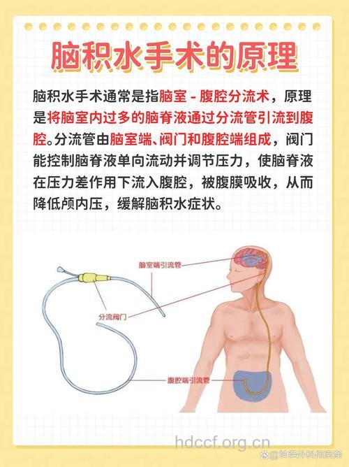 怎么手术治疗脑积水方法