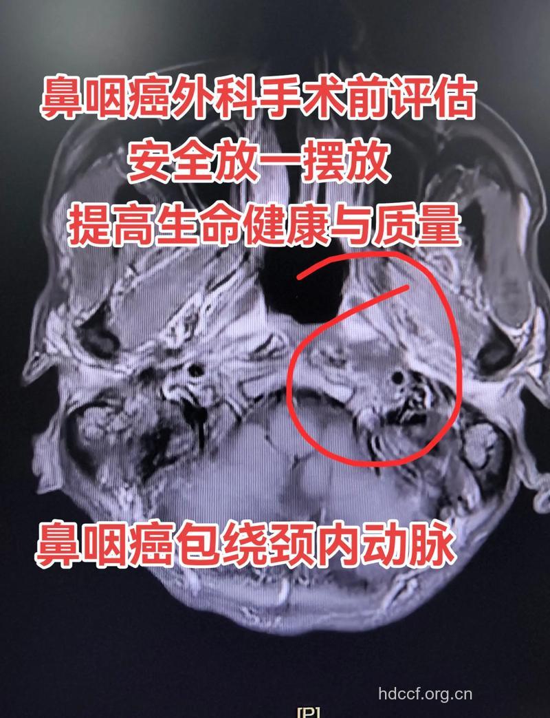 音乐对鼻咽癌病人有帮助吗