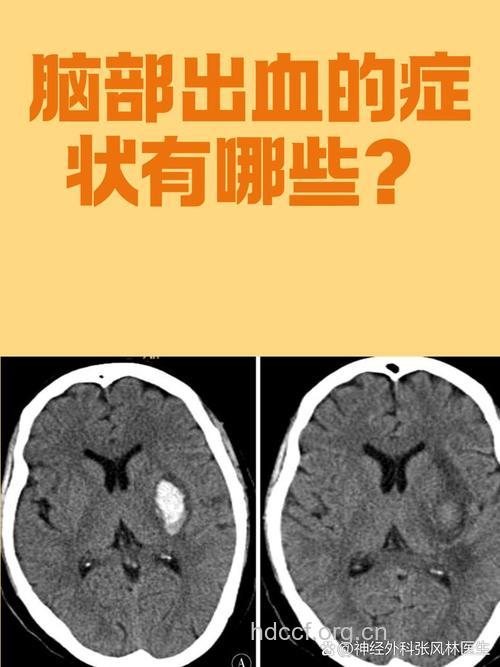 什么是创伤性脑室内出血