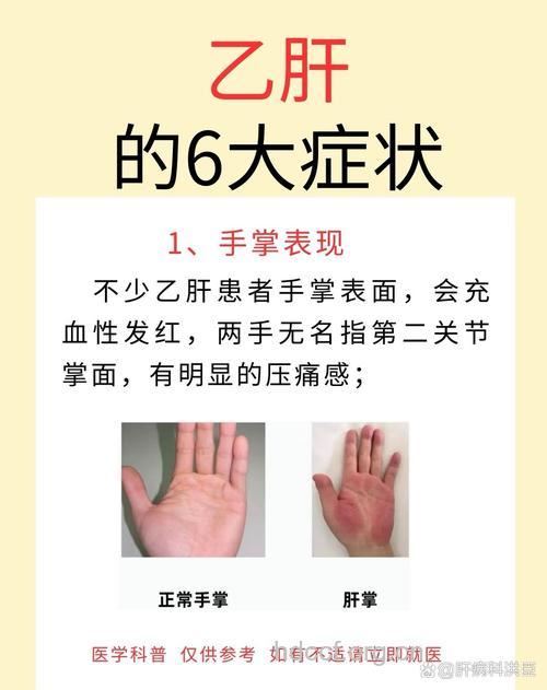 何现象可判断自己感染乙肝