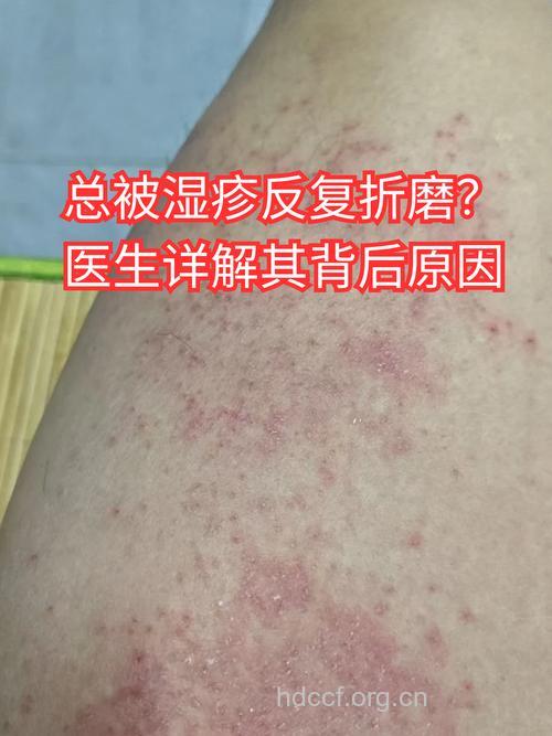 瘙痒难耐原来是湿疹惹的祸