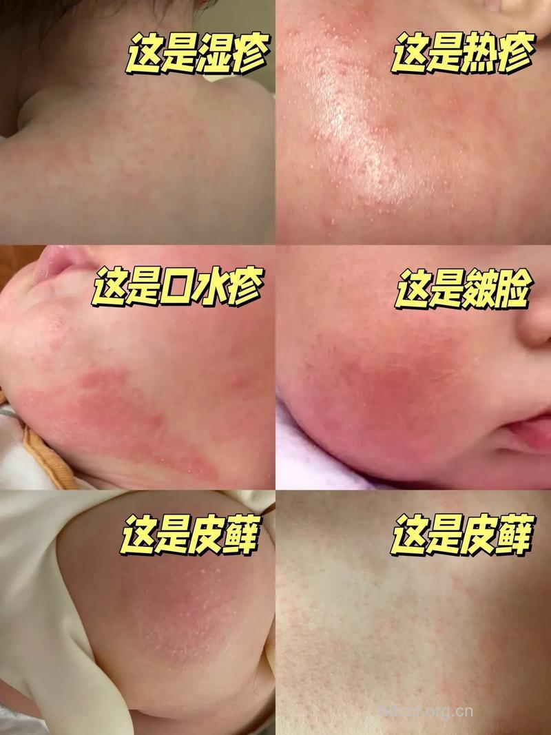 乳酸菌可有效减轻儿童湿疹
