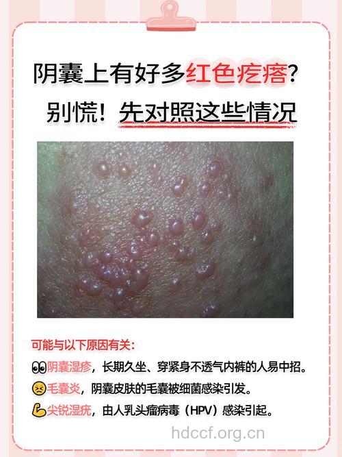 阴囊湿疹的预警方案