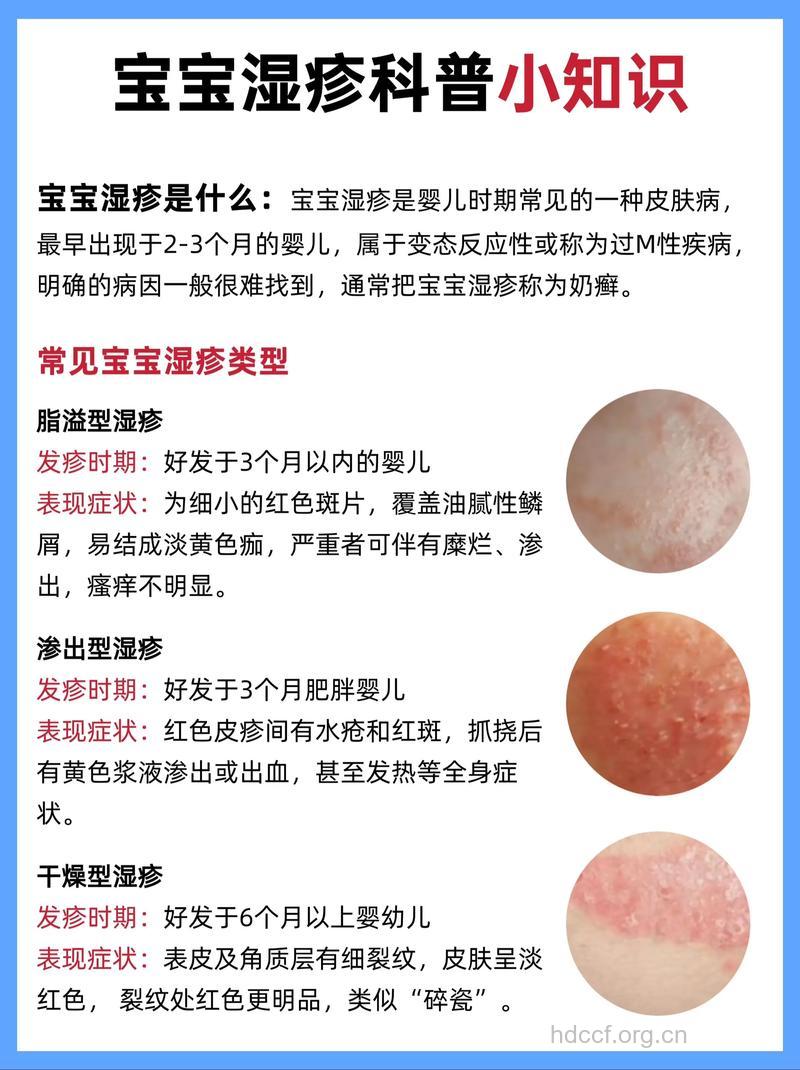 母乳喂养可有效防治小儿湿疹