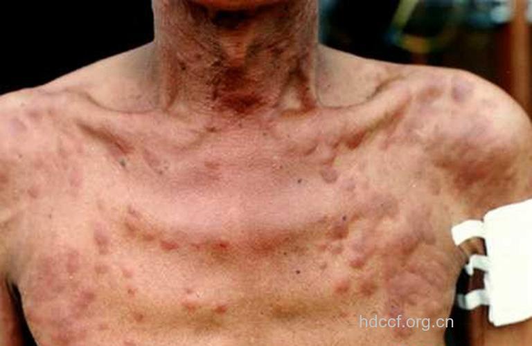 原发性鼻腔淋巴瘤的症状