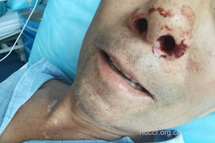 鼻咽癌晚期患者有哪些症状