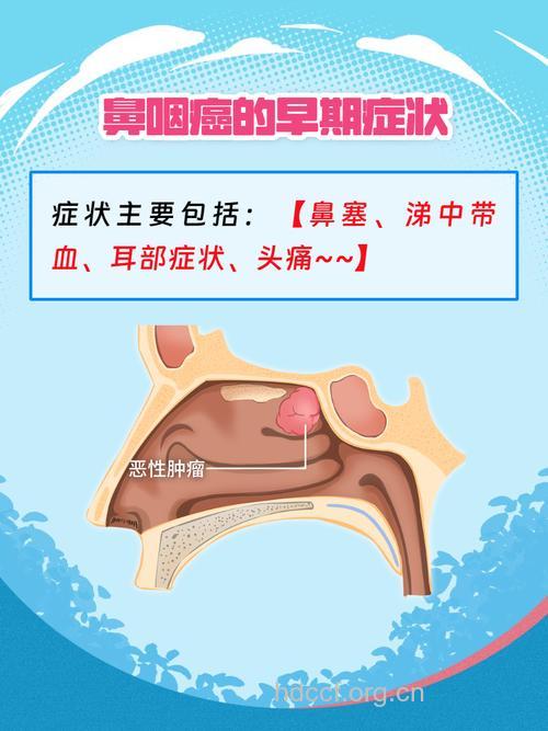 鼻咽癌早期症状是什么