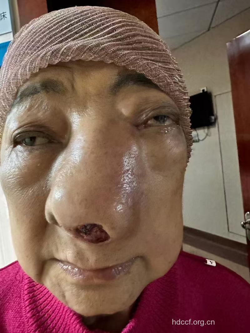 鼻咽癌晚期有哪些特殊表现