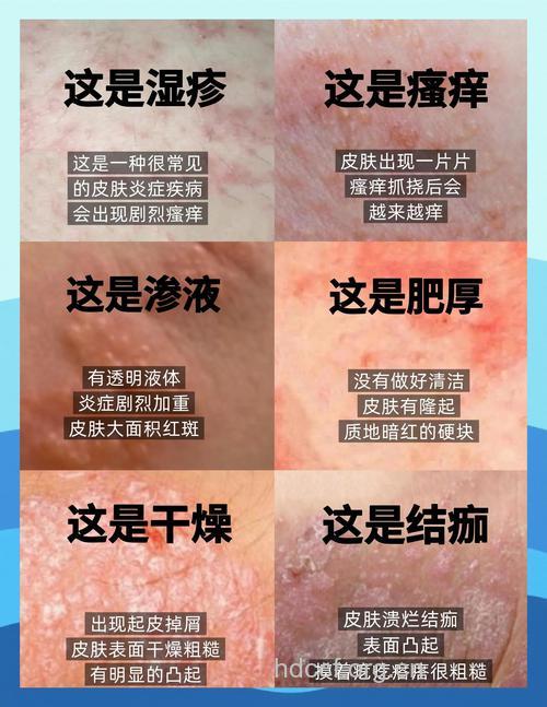 抗炎止痒治疗湿疹效果好