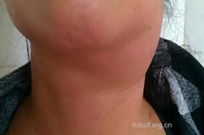 鼻咽癌淋巴转移有哪些症状