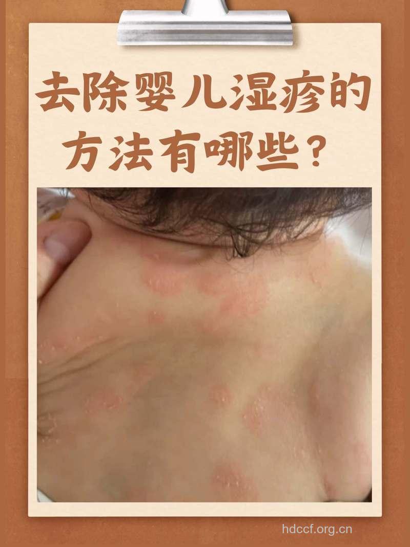 婴儿期降患湿疹风险--吃鱼