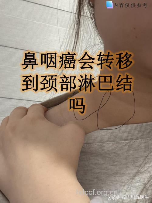 鼻咽癌的转移情况是如何的