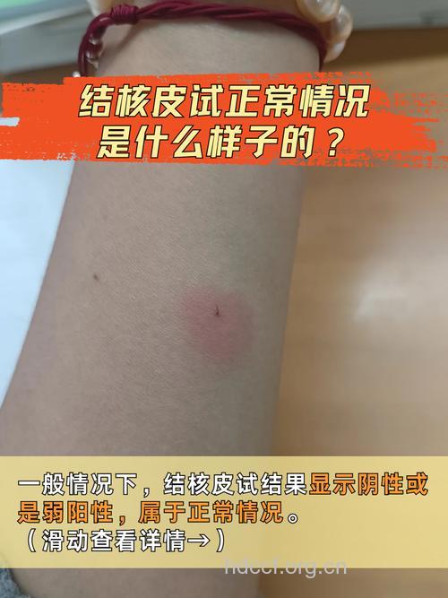 什么是皮试?结果阴性就一定不过敏吗?