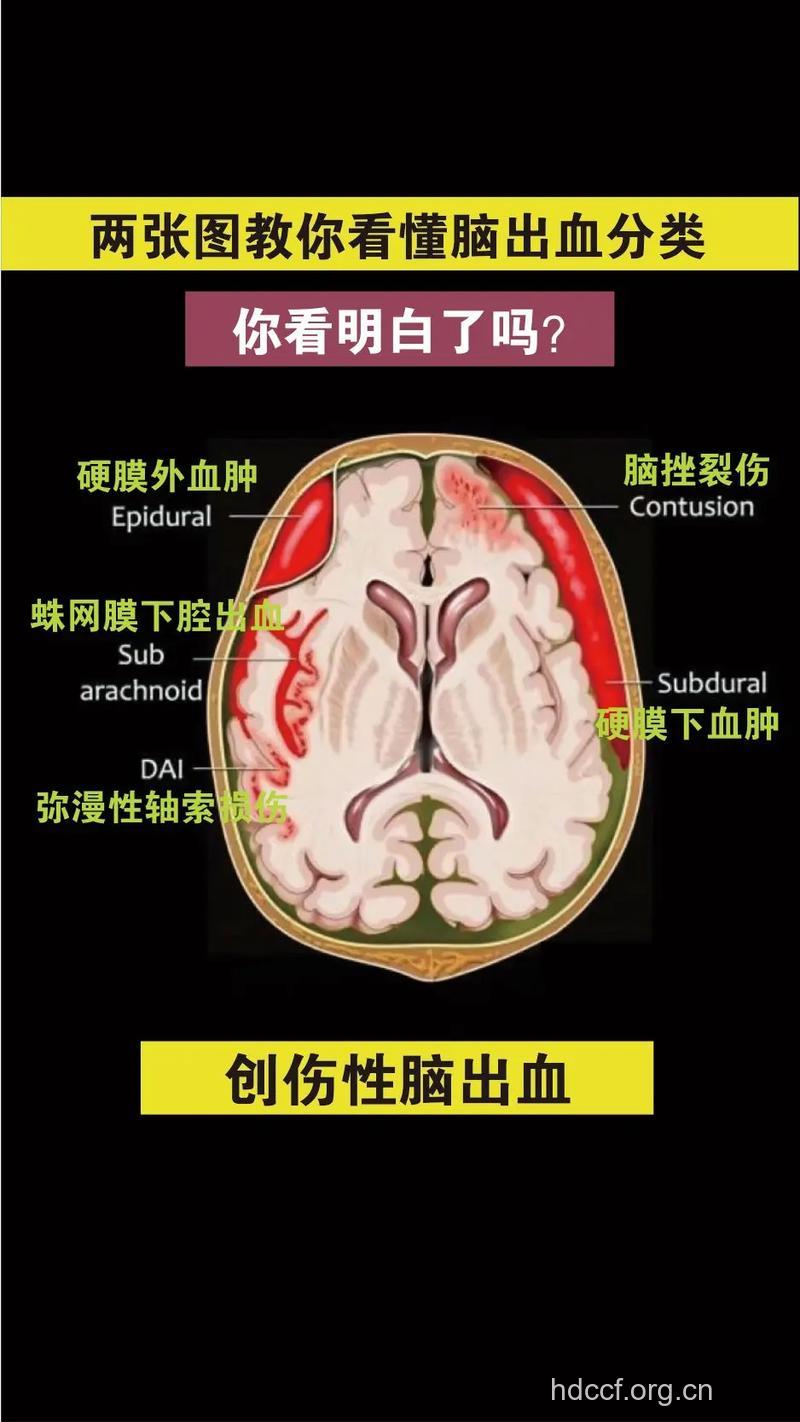 脑出血的分类