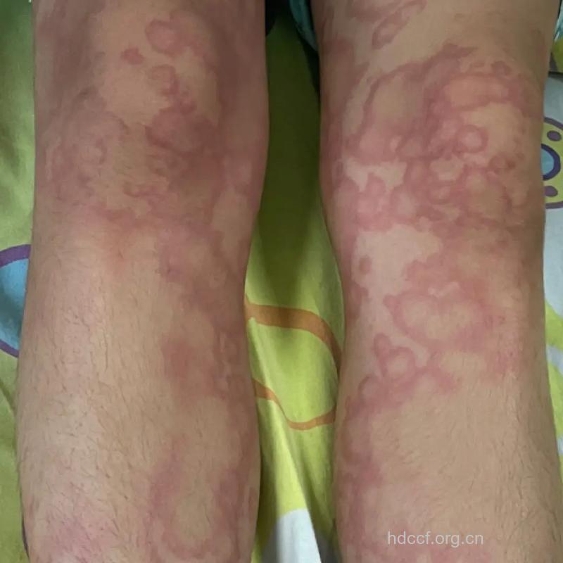 过敏性休克有哪些症状 面色苍白狂打喷嚏