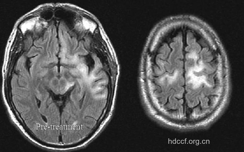 进行性多灶性白质脑病的诊断