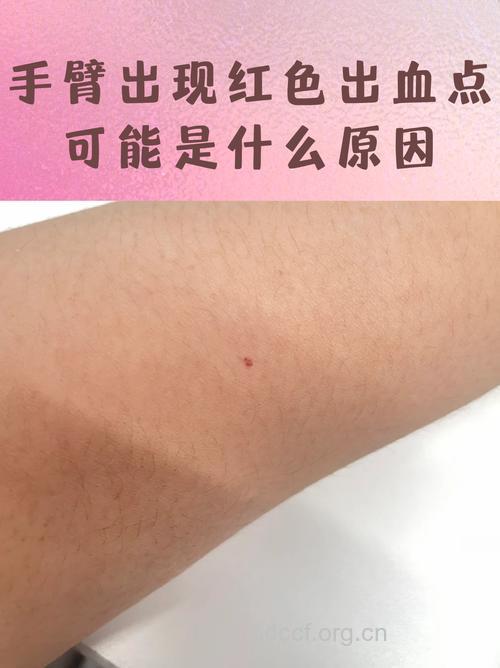 皮肤血管揭露你的乙肝征兆