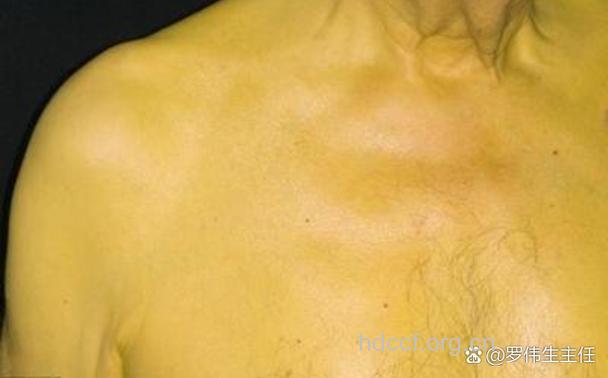 乙肝患者为什么皮肤黄?