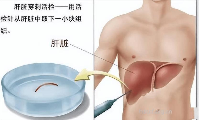 做肝穿的几种情况