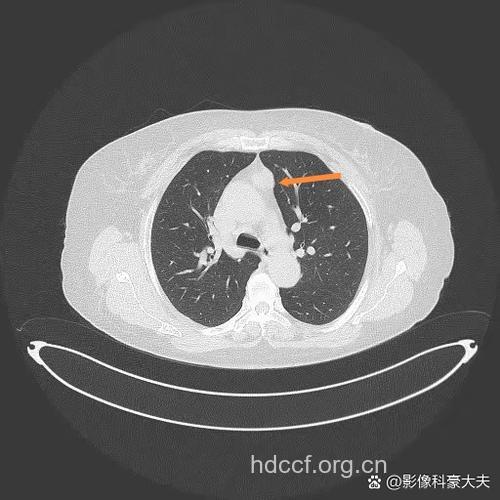 胸腺瘤怎么治疗 这三个方法见效快