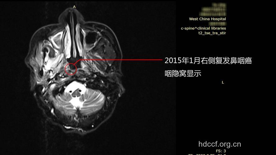 鼻咽癌的影像学诊断?
