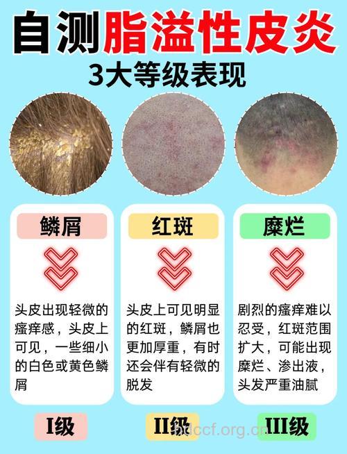 辨别脂溢性皮炎 从症状和特点入手