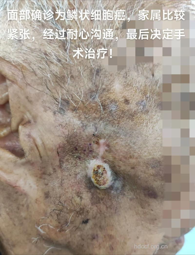 老年肿瘤可以切除吗