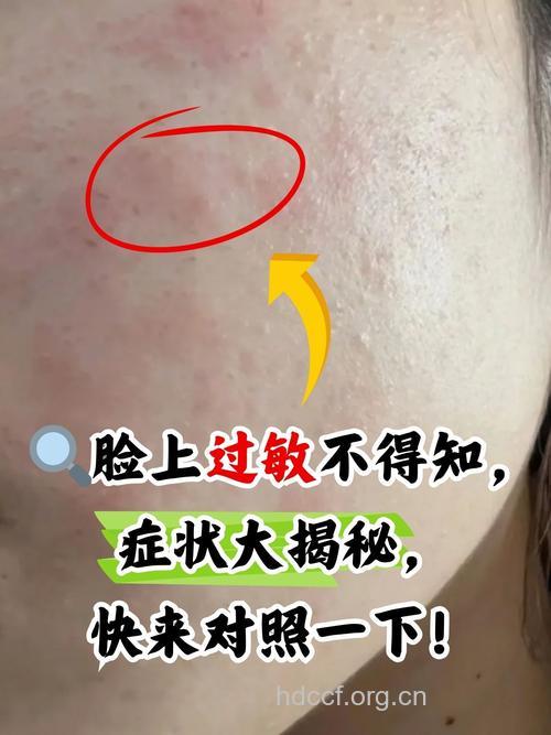 皮肤过敏人群的特征是什么