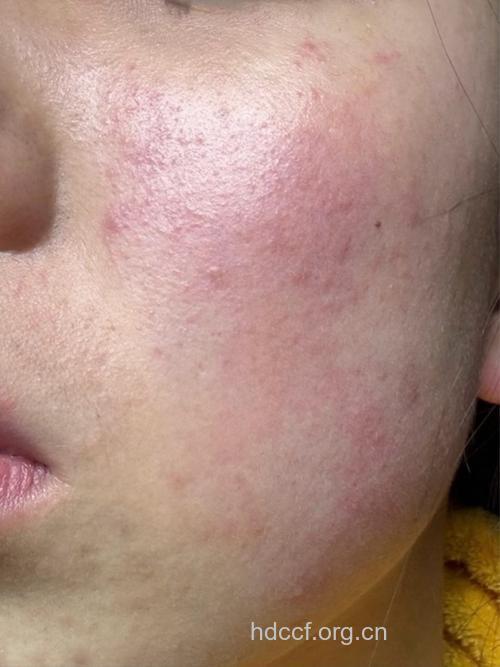 脸上皮肤过敏症状表现有哪些