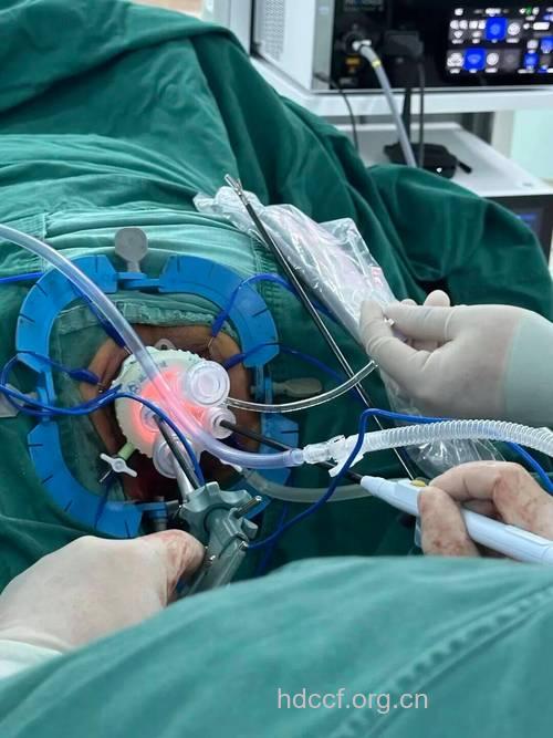 治疗消化道肿瘤的先进技术