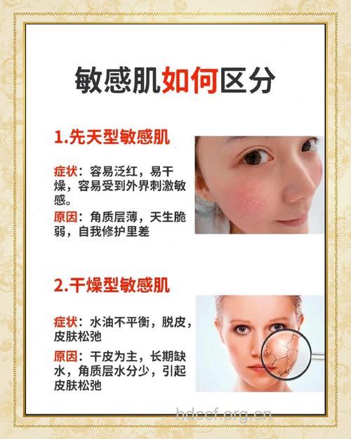 敏感肌肤有哪些常见的特征