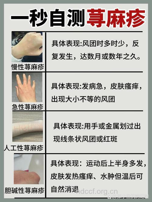 皮肤过敏怎么自我诊断呢