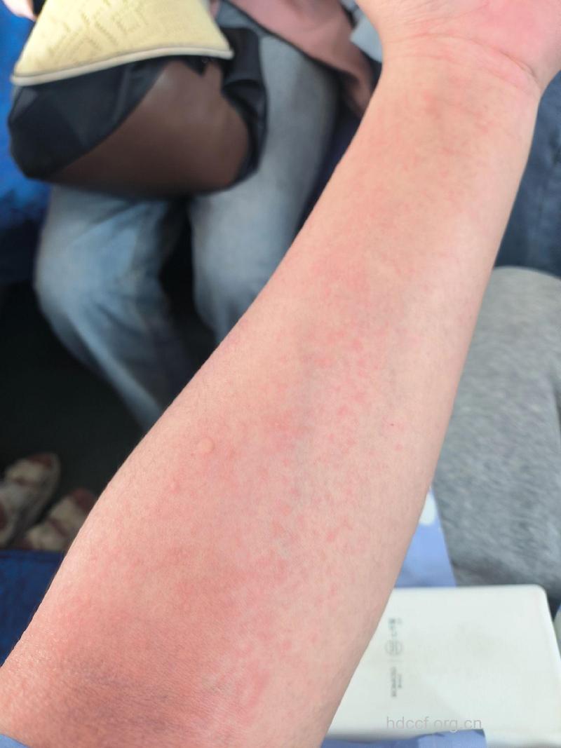 多发的过敏性皮炎有什么症状