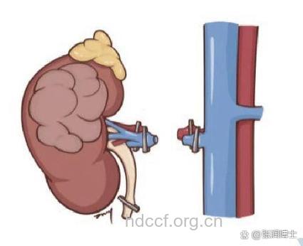 老人患肾癌有哪些治疗方法
