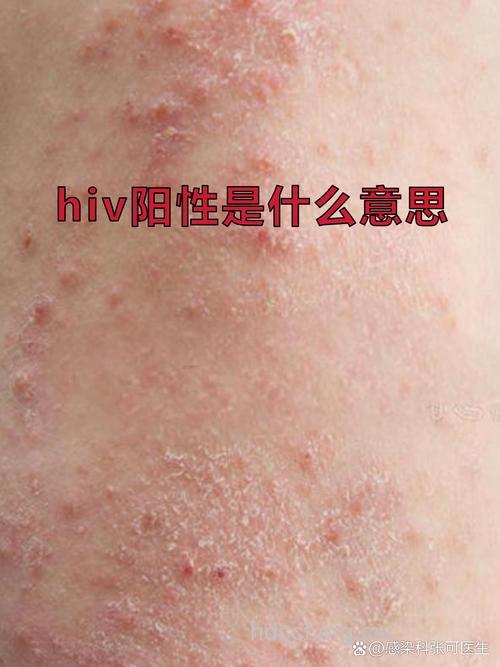 小三阳性爱中易传染?