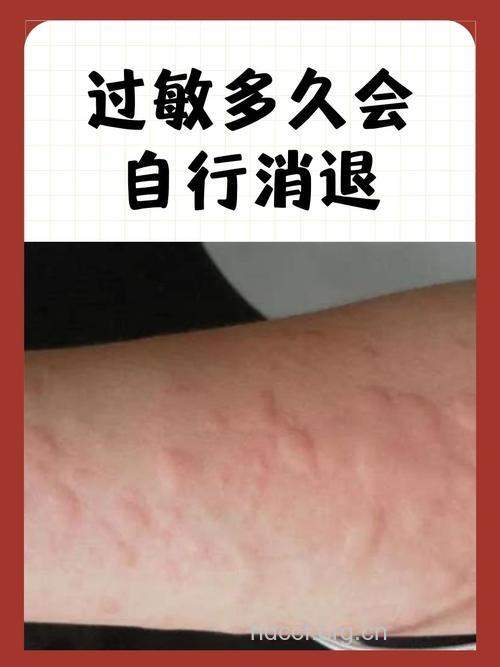 过敏会出现什么症状呢