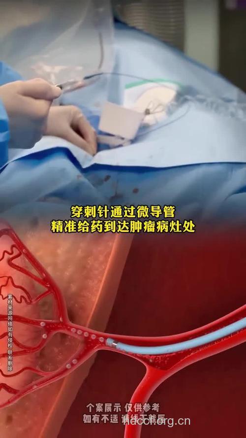 常见肿瘤的介入治疗